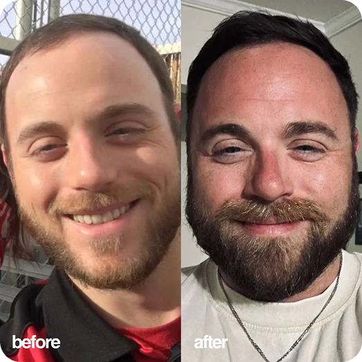 Drew before and after